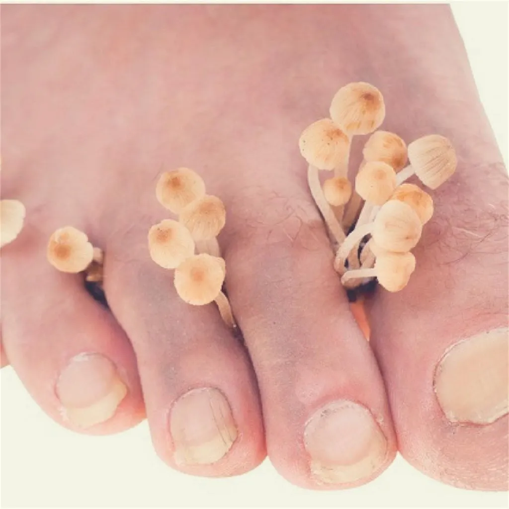 pie-de-atleta-que-es-prevencion-y-tratamiento_img18861t1