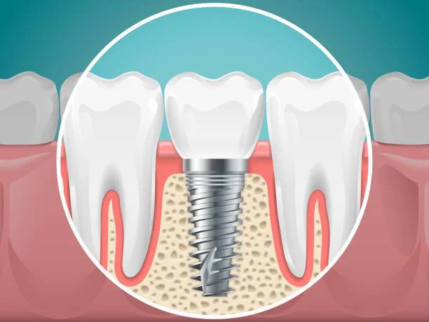 implantes-dentales-1724362461-1724362580-1725057020